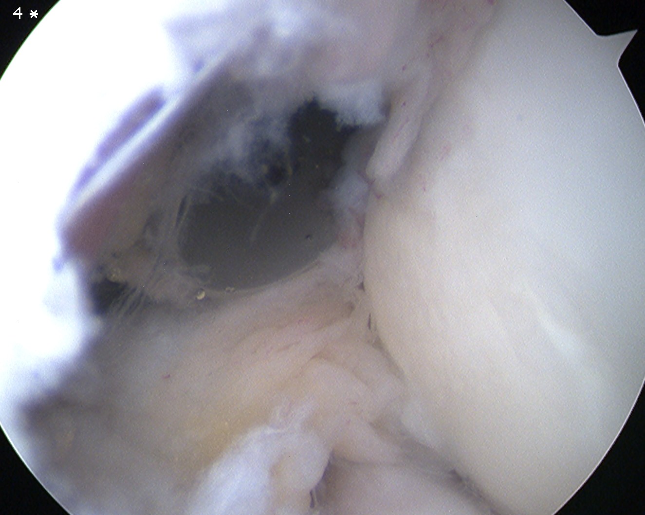 Elbow Scope Anterolateral Portal